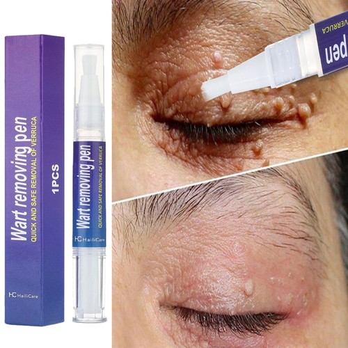 5ml wart remover pen - pen, tag