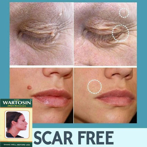 New skin tag remover cream - new,