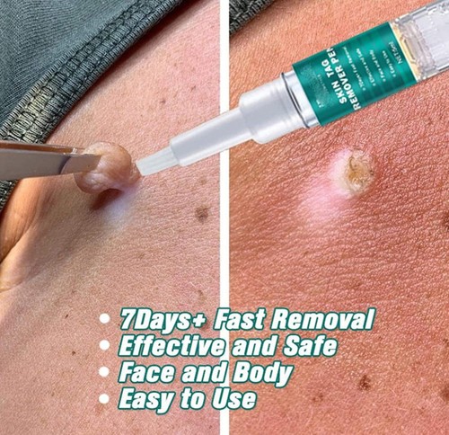 Days wart remover pen - 7,
