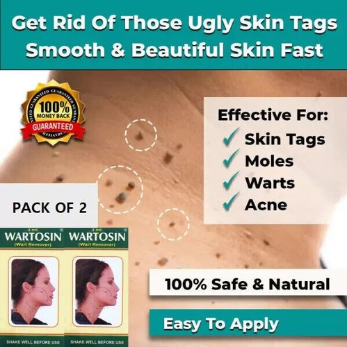 New skin tag - 2x,