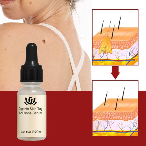 Hours wart remover - remover, tag