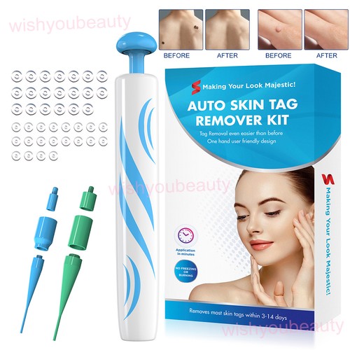 Skin tag removal kit - tag,