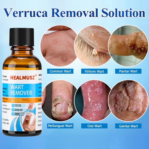 Wart remover liquid - remover,