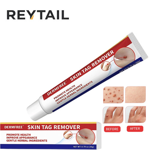 Strong skin tag - skin, cream