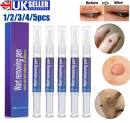 Wart remover pen eliminate - wart,