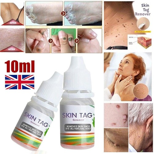 Pro 10ml skin tag cure - uk,