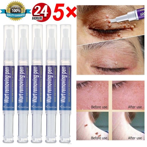 1pc wart remover liquid - remover, skin