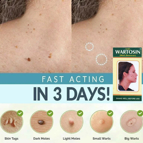 New skin tag - new,