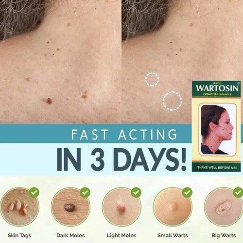New skin tag remover - new,