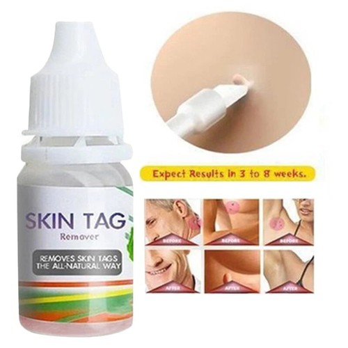 Skin tag cure - skin, removal