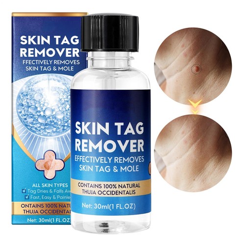 30ml wart remover liquid - remover,