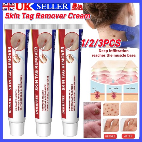 Strong skin tag remover cream - skin,
