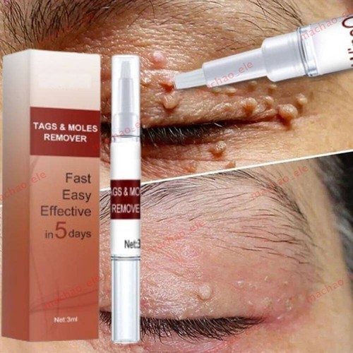 Skin tags moles removal - skin, &